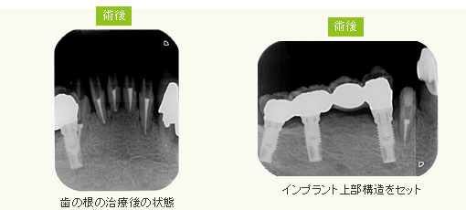 歯の根の治療後の状態　インプラント上部構造をセット